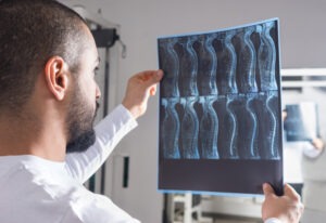 What Qualifies for a Spinal Cord Injury Lawsuit?