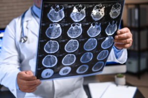 Is a Concussion a Traumatic Brain Injury?